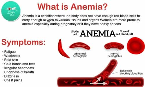 Know all about Sickle Cell Anemia : UPSC Exams